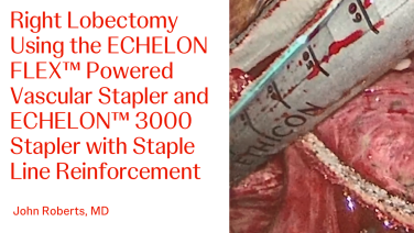 An Image From "Right Lobectomy Using the ECHELON FLEX™ Powered Vascular Stapler and ECHELON™ 3000 Stapler with Staple Line Reinforcement with John Roberts, MD"