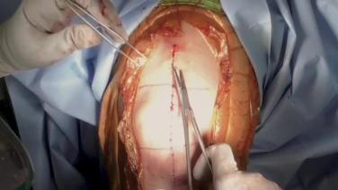 Stratafix and Dermabond Prineo TKA Application Video