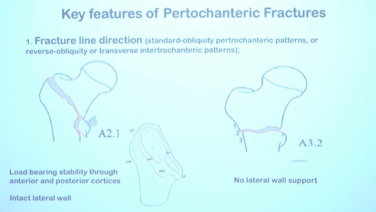 Intertrochanteric Fracture Surgical Pearls
