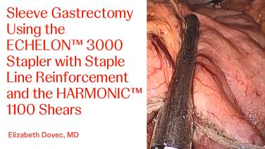 An Image From "Sleeve Gastrectomy Using the ECHELON™ 3000 Stapler with Staple Line Reinforcement and Harmonic™ 1100 Shears with Betsy Dovec, MD