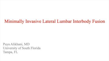 An image from the "Minimally Invasive Lateral Lumbar Interbody Fusion with Puya Alikhani, MD" playlist on the JnJInstitute.com website.