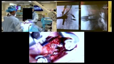 An Image From "MIS TLIF: Performing a Discectomy"