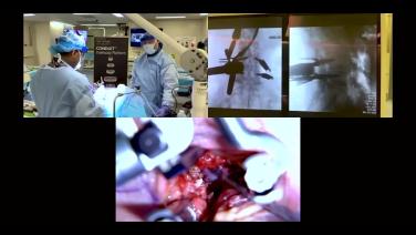 An Image From "MIS TLIF: Preventing and Repair Dural Tears"