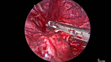 Thorascopic Lobectomy - Staple and Divide the Pulmonary Artery