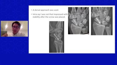 Surgical Management of Upper Extremity Fractures with Ben Chia, MD; Asif Ilyas, MD & Peter Tang, MD