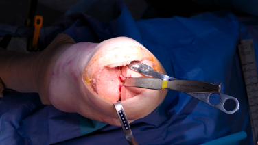 ATTUNE Revision Knee Procedure Featuring Stems and Sleeves with Timothy Alton, MD & David Anderson, MD