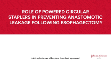 The role of powered circular staplers in preventing anastomotic leakage following esophagectomy thumbnail