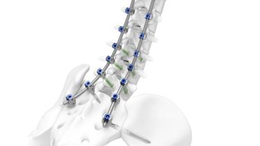 Thoracic Kyphosis Correction with Alekos Theologis, MD