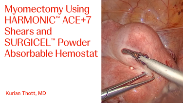 An Image From "Myomectomy Using HARMONIC™ ACE+7 Shears and SURGICEL™ Powder Absorbable Hemostat with Kurian Thott, MD"
