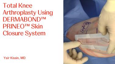 An image from the "Using DERMABOND PRINEO Skin Closure System in TKA with Yair Kissin, MD" video on the JnJInstitute.com website.