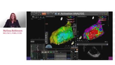 Substrate Mapping VT in Ischemic Cardiomyopathy with Melissa Robinson, MD thumbnail