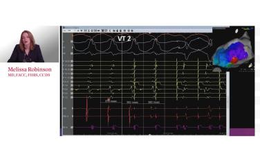 Ablating VT in Ischemic Cardiomyopathy with Melissa Robinson, MD thumbnail