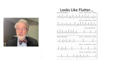 Atrial Flutter Soup to Nuts with John Miller, MD thumbnail