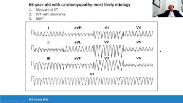 Clinical Cardiac Electrophysiology Evolution & Clinical Cases with Jasbir Sra, MD thumbnail