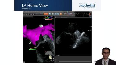 Transitioning from TEE to ICE by Integrating the CARTOSOUND® Module for Optimal LAA Visualization with Apoor Patel, MD thumbnail