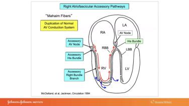 An Image From "Use of ECG and Intracardiac Recordings to Diagnose and Demonstrate the Electrophysiologic Characters of Atriofascicular and Atroventricular Type "Mahaim" Fibers with Warren 