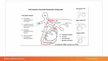 An IMage From "Fascicular VT with Melvin Scheinman, MD"