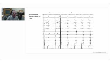 An Image From "AVNRT LLAP Case Presentation with Melvin Scheinman, MD"