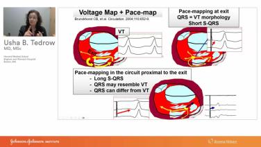 An Image From "Use of ECG and Entrainment to Identify Mechanism and Critical Sites for Catheter Ablation of Ventricular Arrhythmias with Usha Tedrow, MD"