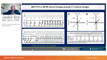 An Image From "Physiologic Basis for Wide Complex Tachycardias including BBVT with Jasbir Sra, MD"