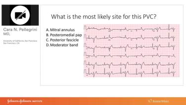 An Image From "Clinical and ECG Recognition of the Malignant Mitral Valve Prolapse Syndrom with Cara Pellegrini, MD"