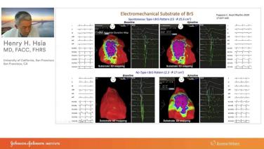 An Image From "ECG Diagnosis and Catheter Ablation in Patients with Genetic Arrhythmia Syndromes with Henry Hsia, MD"