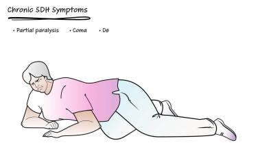 An image from "Chronic Subdural Hematoma Education Video"