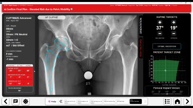 Image from CUPTIMIZE™ Advanced Hip-Spine Analysis & Guidance: Pre-operative Plan
