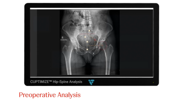 An Image From "ANTERIOR ADVANTAGE™ MATTA METHOD™ Procedural Workflow - Anay R. Patel, MD"