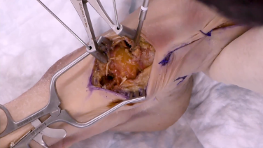 Image from Dorsal Approach Talonavicular Joint Arthrodesis with Alan Ng, DPM