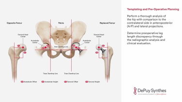Image from EMPHASYS™ Acetabular Surgical Technique Animation