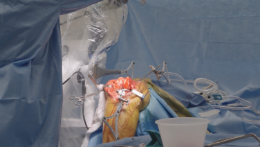 Image from Technology and Efficiency in the ASC Setting: Tibial First Workflow and Personalized Alignment with VELYS Robotic-Assisted Solution - Timothy B. Alton, MD