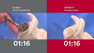 GLOBAL APG v. INHANCE Shoulder System Animation thumbnail