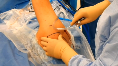 image from Rotator Cuff Repair with Anthony Scillia, MD