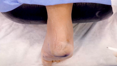 Image from Flexor Digitorum Longus Tendon Transfer - Michael Campbell, MD