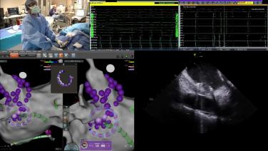 VARIPULSE™ workflow with Dr. Kousik Krishnan: A live PAF case