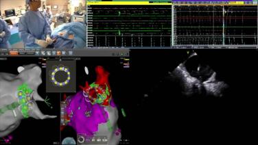 Concomitant case with VARIPULSE™ Platform and NUVISION™ NAV Ultrasound Catheter