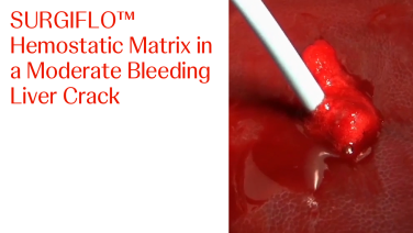 An image of the "SURGIFLO Hemostatic Matrix Kit in a Moderate Bleeding Liver Crack" video.