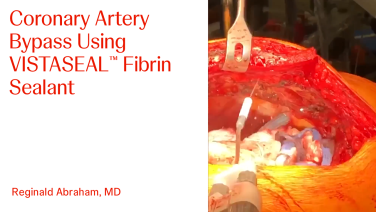 An Image From "Coronary Artery Bypass Using VISTASEAL™ Fibrin Sealant with Reginald Abraham, MD"