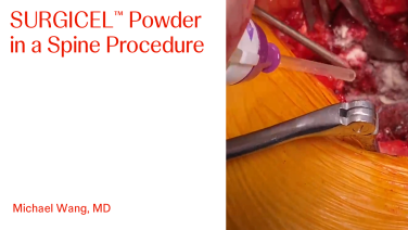 An Image From "SURGICEL™ Powder in a Spine Procedure with Michael Wang, MD"