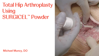 An image From "Total Hip Arthroplasty Using SURGICEL™ Powder with Michael Muncy, DO"