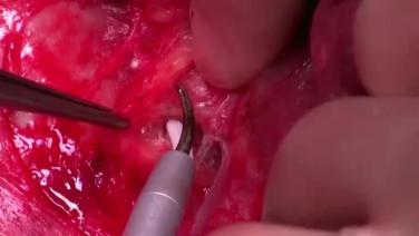 An image From "Whipple Procedure Using HARMONIC FOCUS™+ Long Shears with Jeremy French, MD "