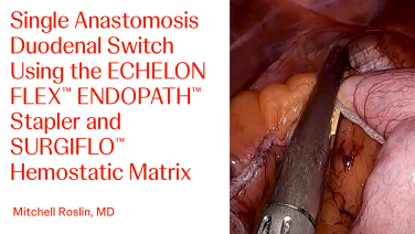 Thumbnail image of Single Anastomosis Duodenal Switch Using the ECHELON FLEX™ ENDOPATH™ Stapler and SURGIFLO™ Hemostatic Matrix with Mitchell Roslin, MD