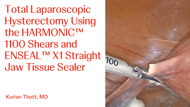 An Image From "Total Laparoscopic Hysterectomy Using HARMONIC™ 1100 Shears and ENSEAL™ X1 Straight Jaw Tissue Sealer with Kurian Thott, MD"