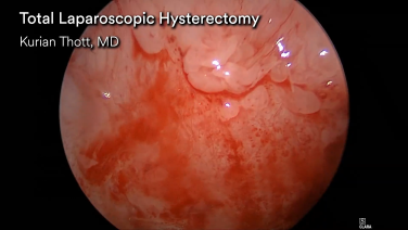 An Image From "Total Laparoscopic Hysterectomy Using HARMONIC™ 1100 Shears and SURGICEL™ Powder Absorbable Hemostat with Kurian Thott, MD"