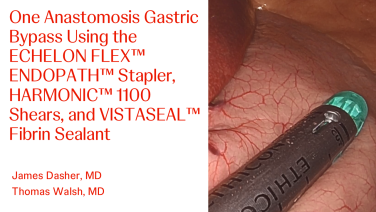 An Image From "One Anastomosis Gastric Bypass Using the ECHELON FLEX™ ENDOPATH™ Stapler, HARMONIC™ 1100 Shears, and VISTASEAL™ Fibrin Sealant with James Dasher, MD and Thomas Walsh, MD"