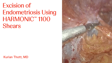 An Image From "Excision of Endometriosis Using HARMONIC™ 1100 Shears with Kurian Thott, MD"