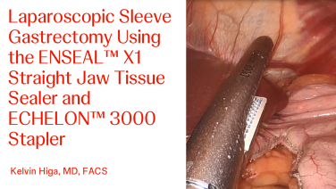 An Image From "Laparoscopic Sleeve Gastrectomy Using the ENSEAL™ X1 Straight Jaw Tissue Sealer and ECHELON™ 3000 Stapler with Kelvin Higa, MD"