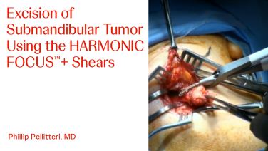 An image from "Excision of Submandibular Tumor Using the HARMONIC FOCUS™+ Shears with Phillip Pellitteri"