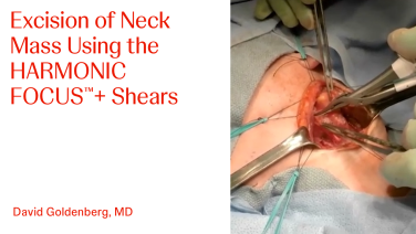 An Image From "Excision of Neck Mass Using the HARMONIC FOCUS™+ Shears with David Goldenberg, MD"